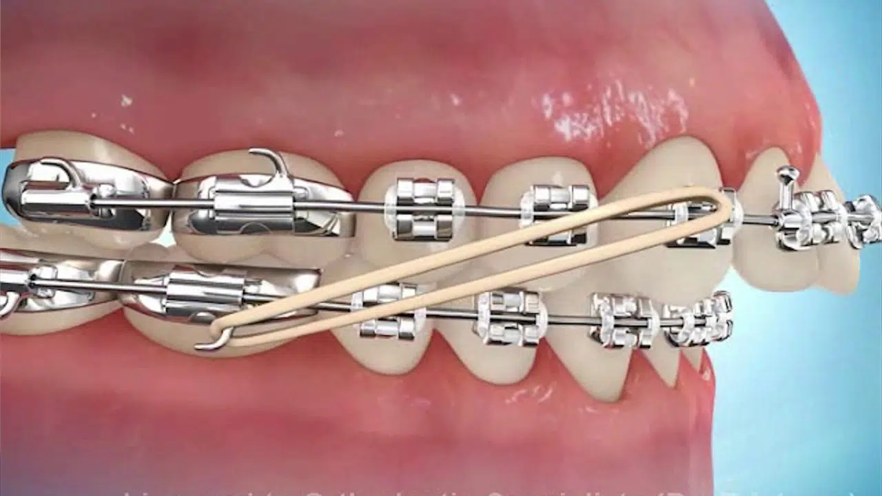 Braces with Rubber Bands: Purpose and How Long They Stay On