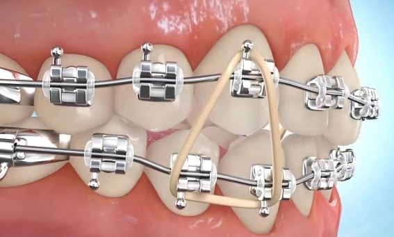 Types of Orthodontic Elastics And Why You Need to Wear Them