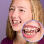 young female wearing braces with orthodontic elastics