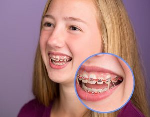 young female wearing braces with orthodontic elastics