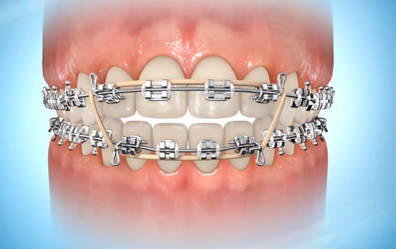 Elastics (Rubber Bands) in Orthodontic Treatment