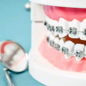 braces for a healthy smile