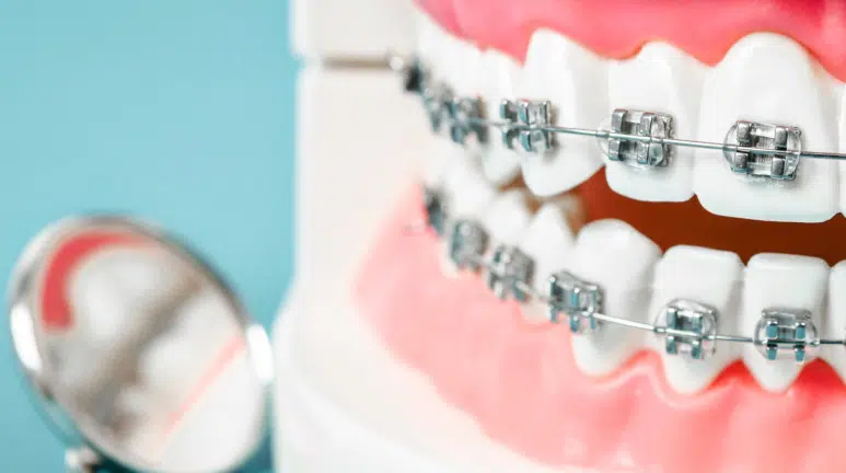 Thinking about Braces? Our Top Asked Questions Answered!