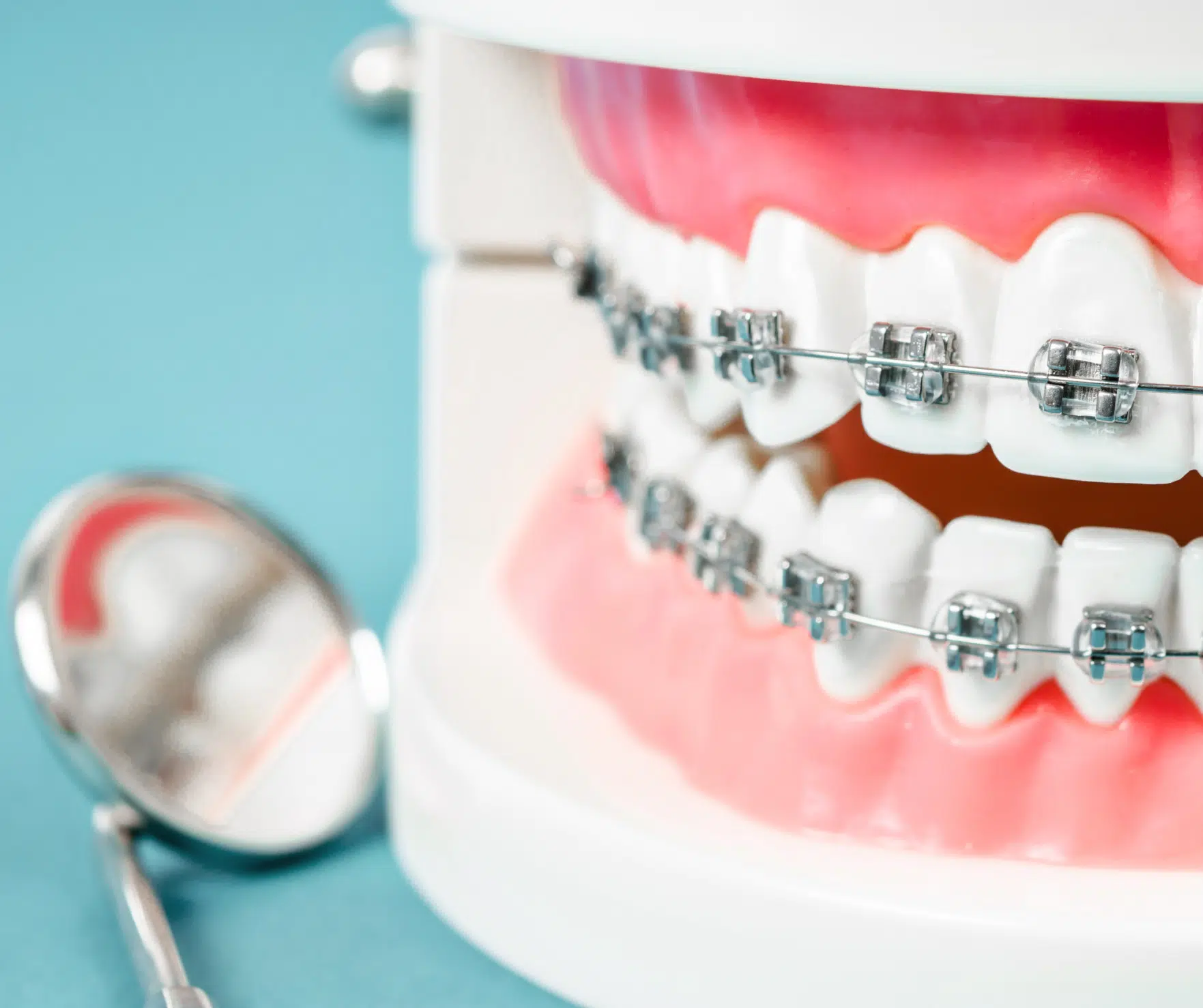 Thinking about Braces? Our Top Asked Questions Answered!